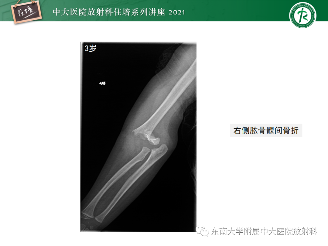 影像PPT - 【PPT】儿童骨关节损伤-42