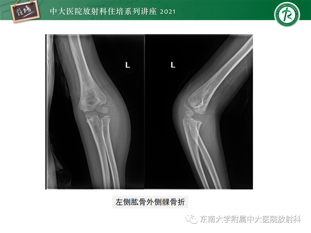 影像PPT - 【PPT】儿童骨关节损伤-44