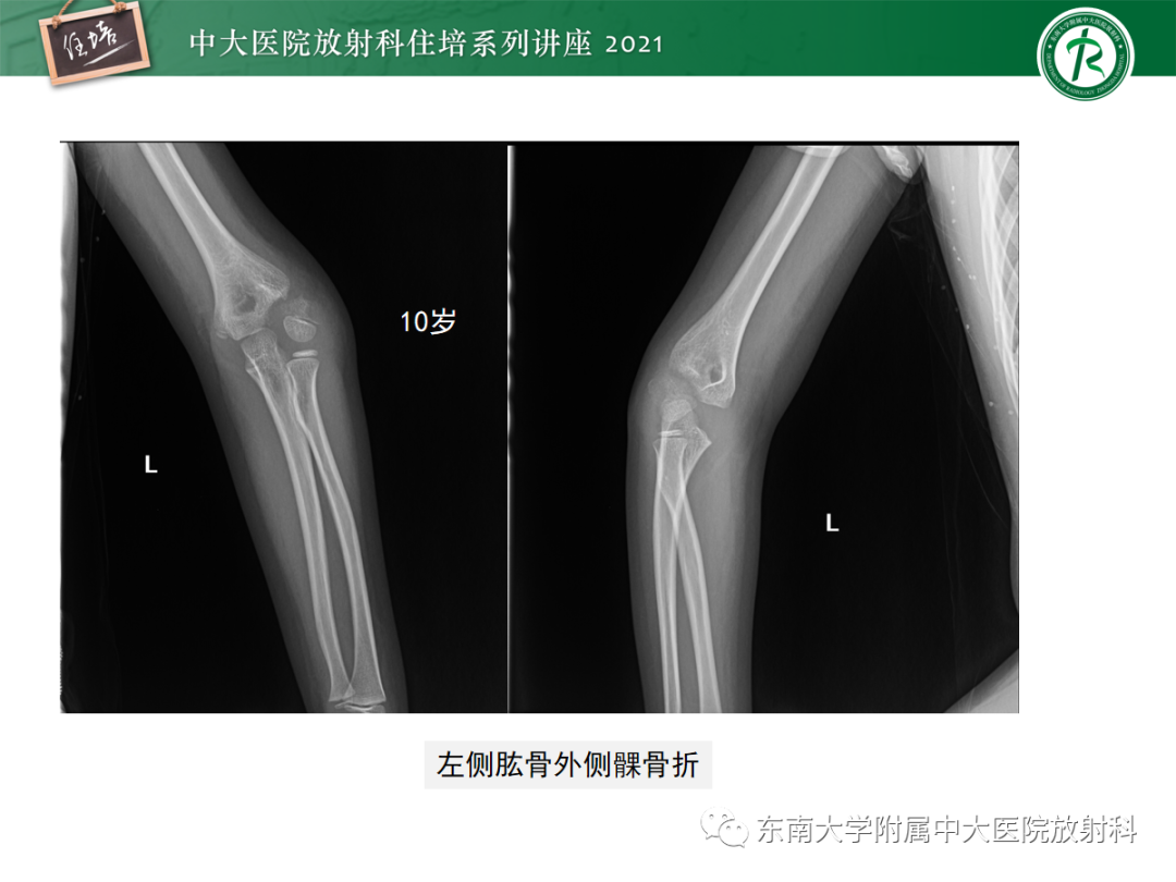 影像PPT - 【PPT】儿童骨关节损伤-45