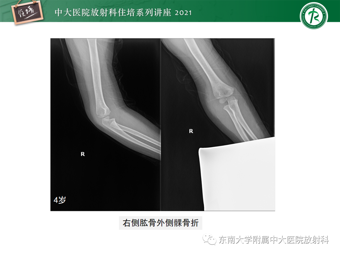 影像PPT - 【PPT】儿童骨关节损伤-46