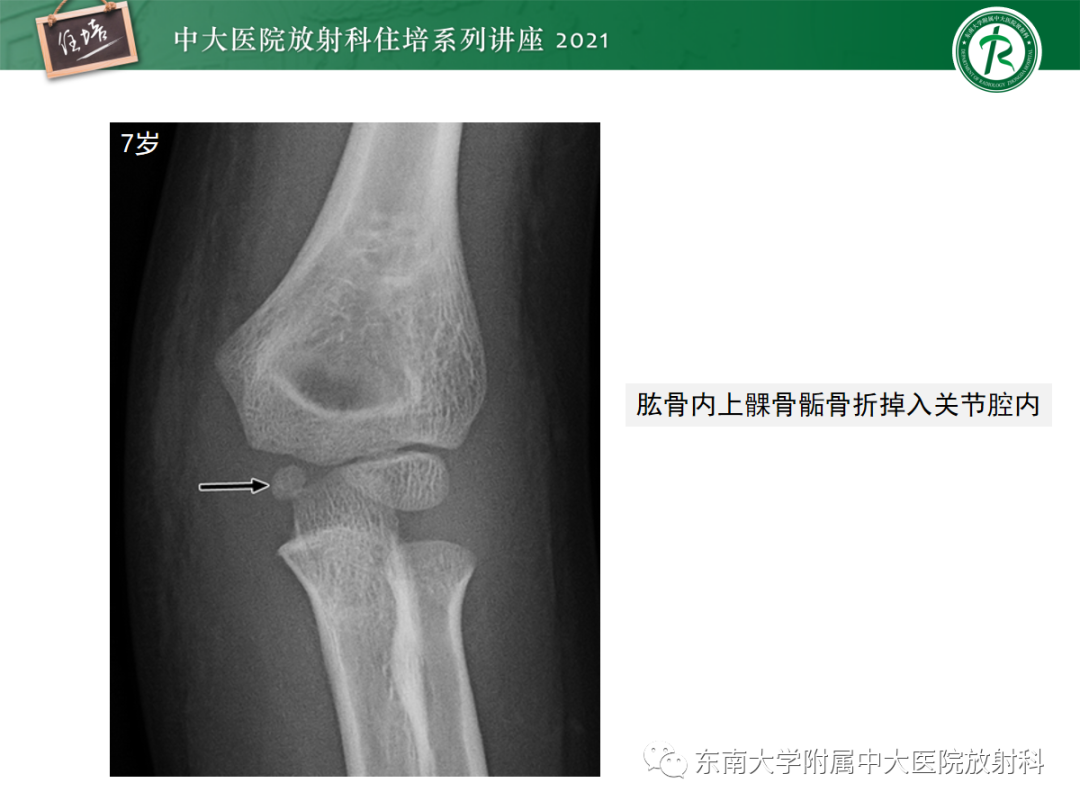 影像PPT - 【PPT】儿童骨关节损伤-49
