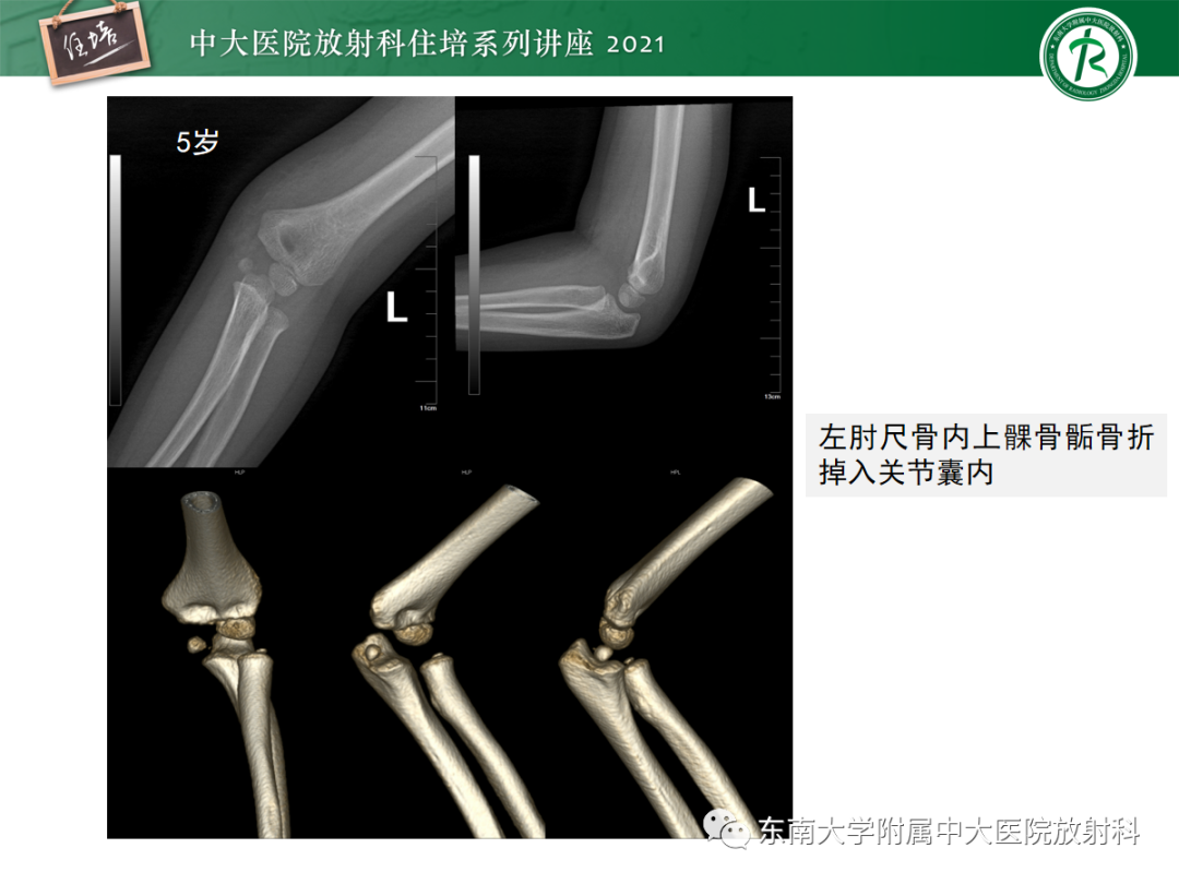 影像PPT - 【PPT】儿童骨关节损伤-48