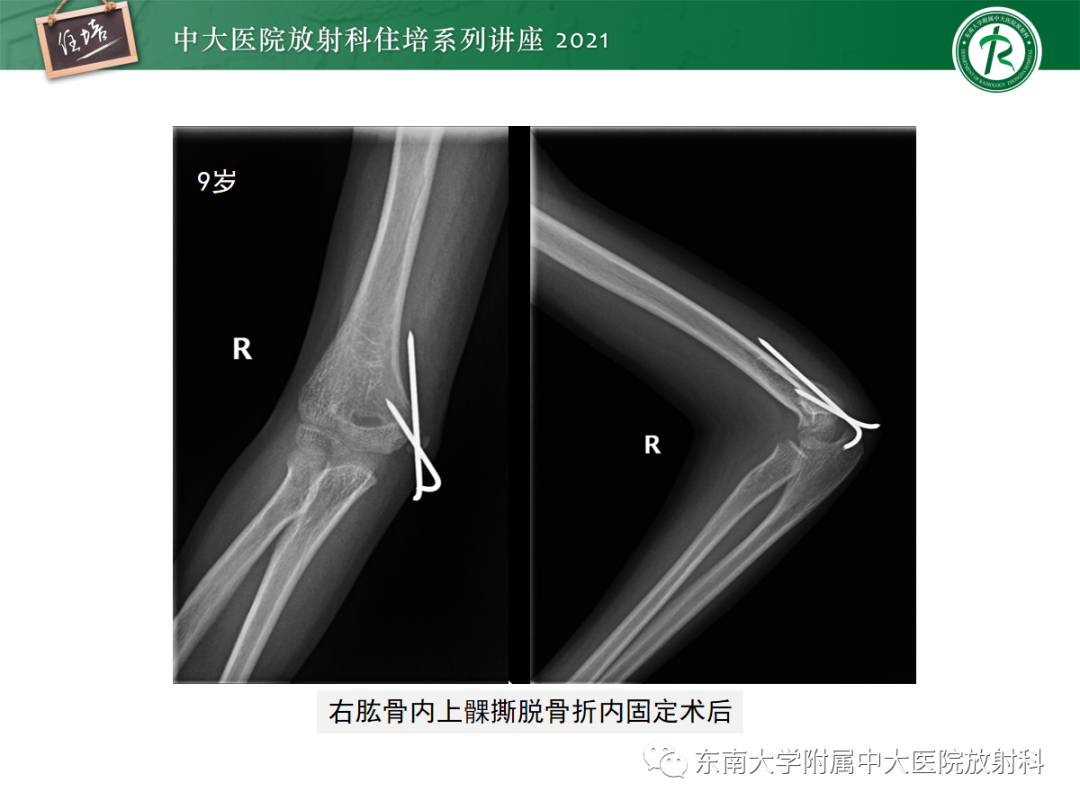 影像PPT - 【PPT】儿童骨关节损伤-50