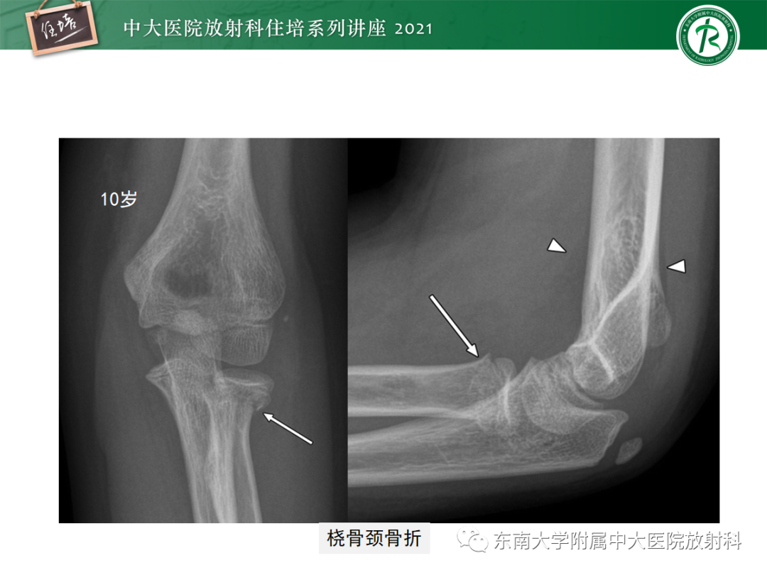 影像PPT - 【PPT】儿童骨关节损伤-52