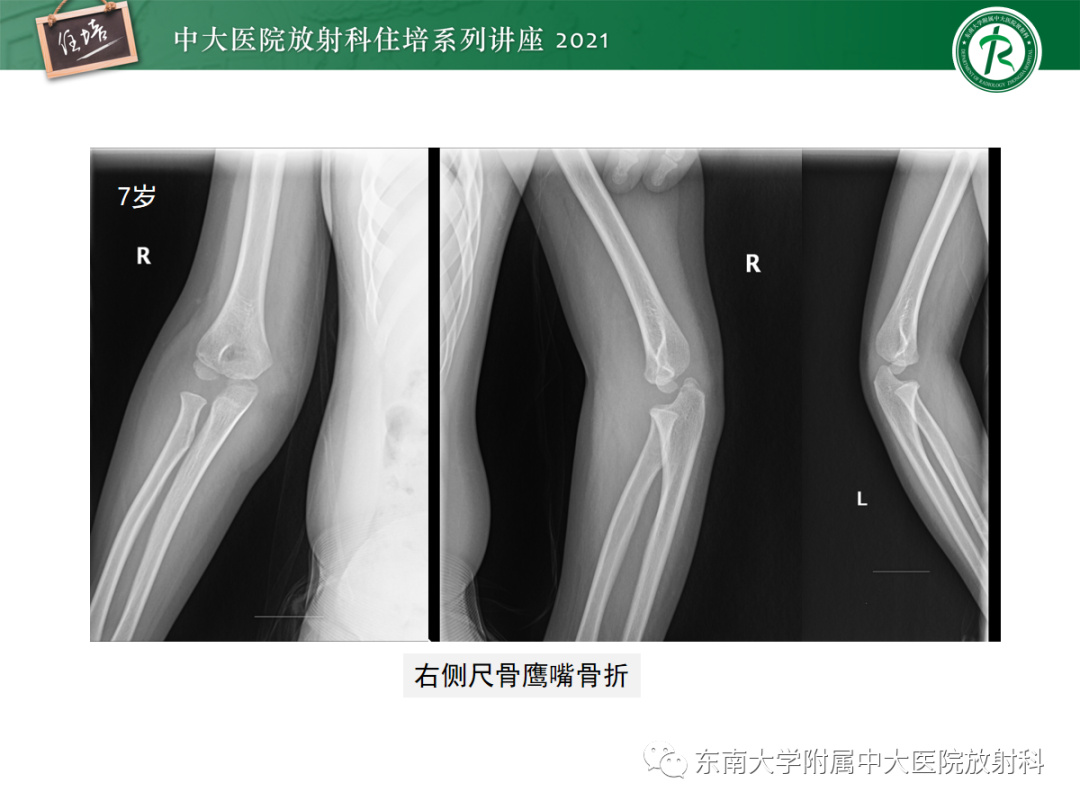 影像PPT - 【PPT】儿童骨关节损伤-54