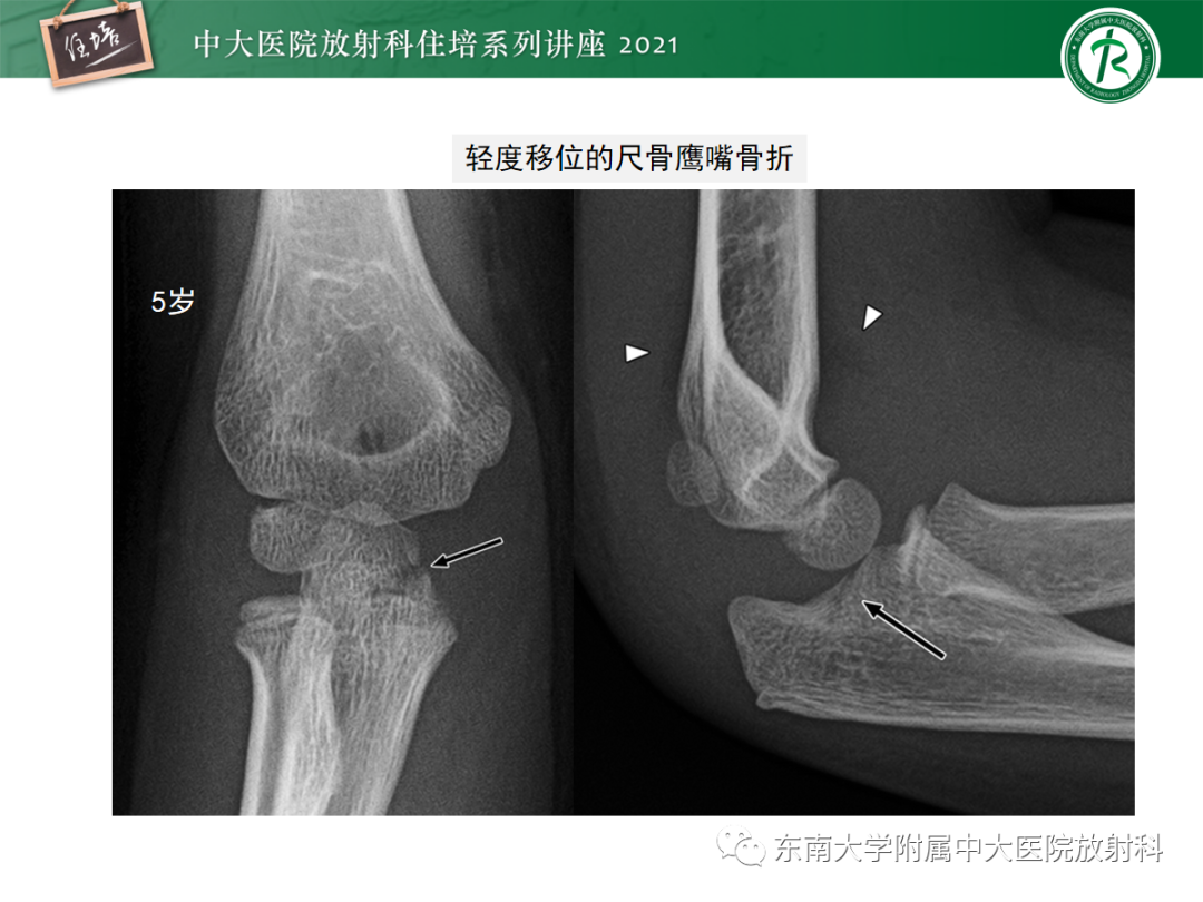 影像PPT - 【PPT】儿童骨关节损伤-55