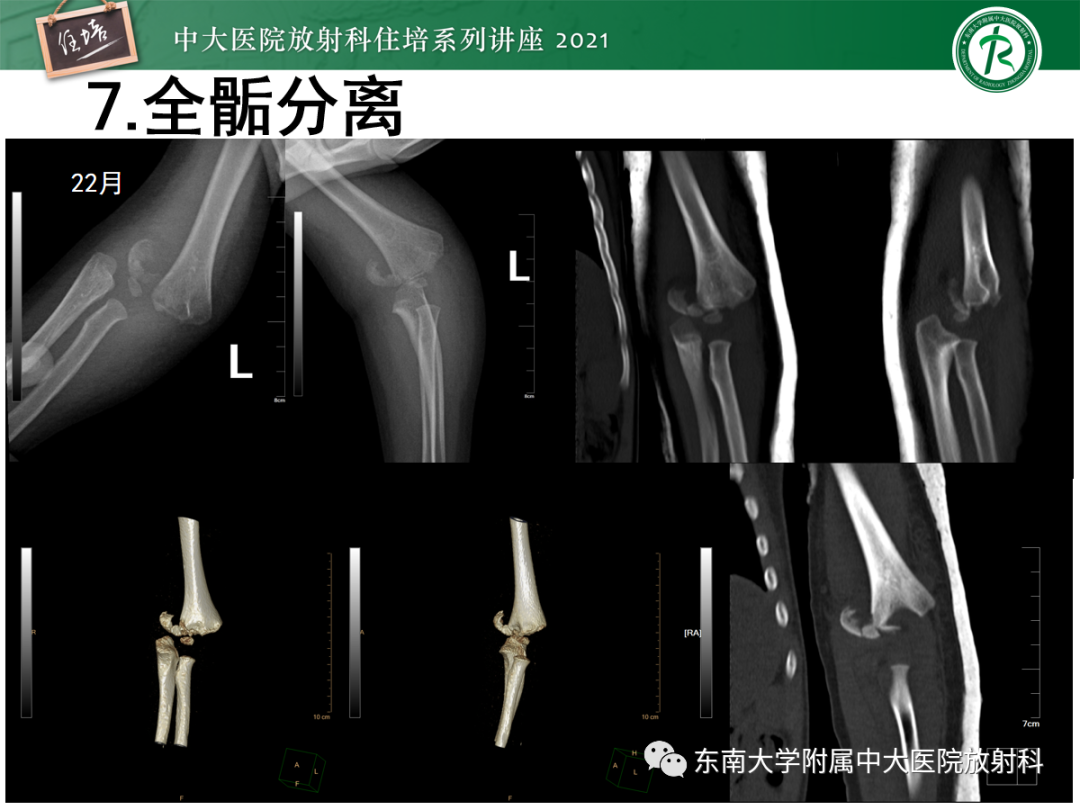 影像PPT - 【PPT】儿童骨关节损伤-57