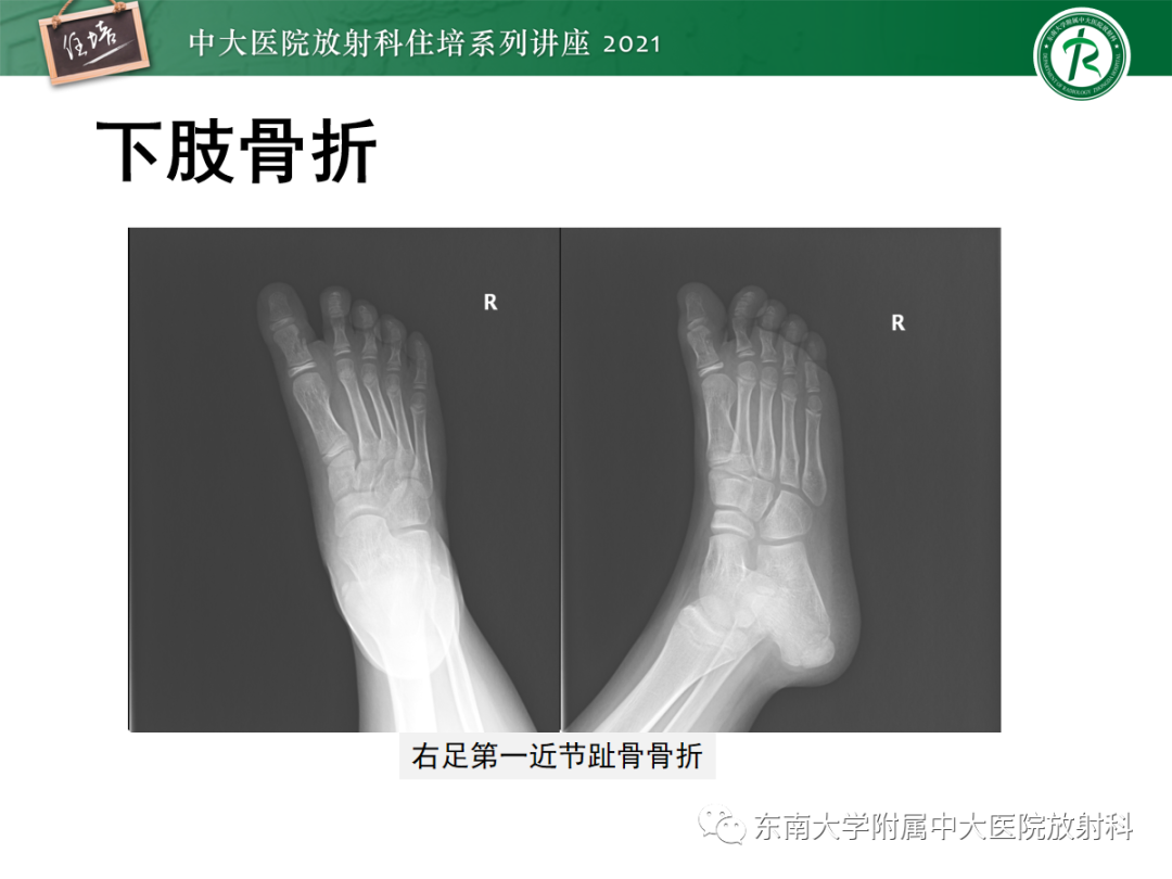影像PPT - 【PPT】儿童骨关节损伤-59