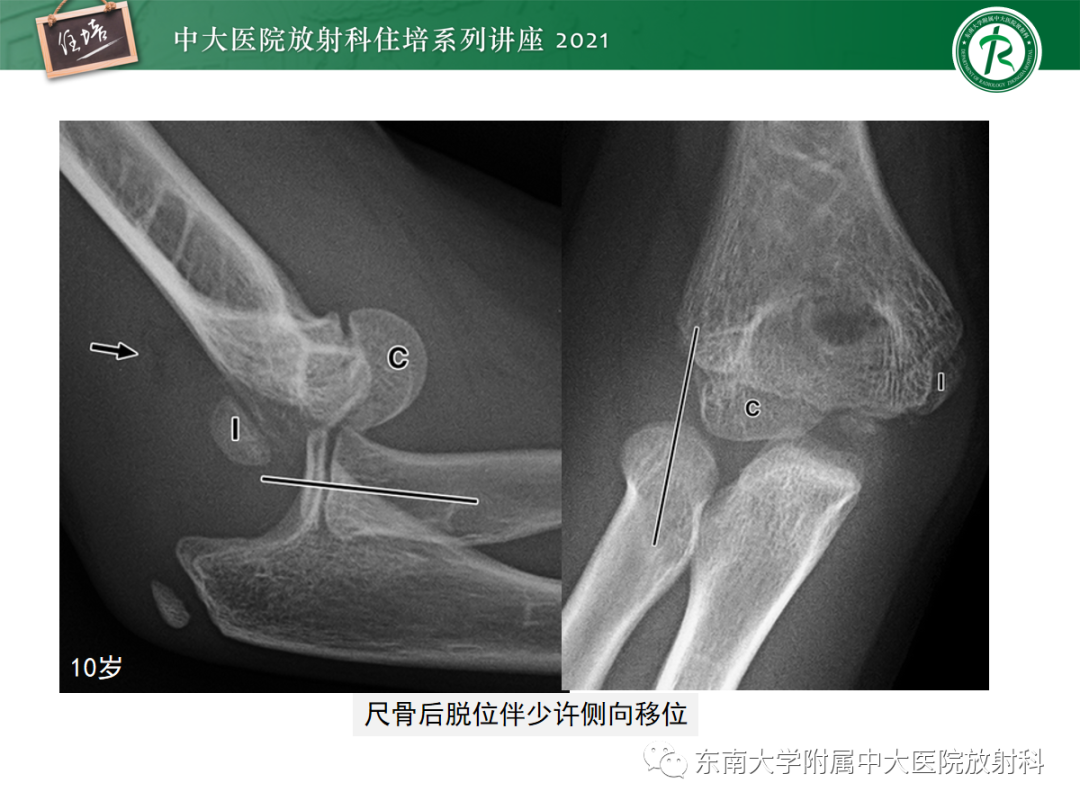 影像PPT - 【PPT】儿童骨关节损伤-58