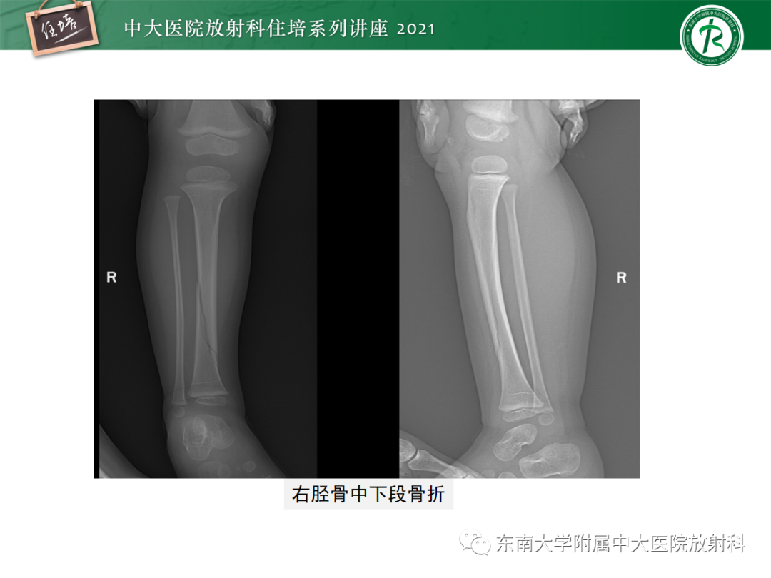 影像PPT - 【PPT】儿童骨关节损伤-60