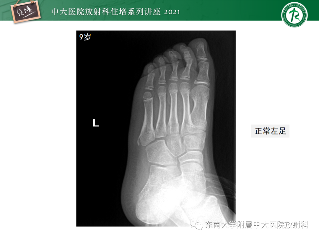 影像PPT - 【PPT】儿童骨关节损伤-62