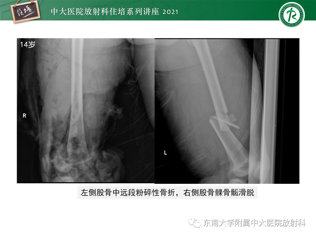 影像PPT - 【PPT】儿童骨关节损伤-61