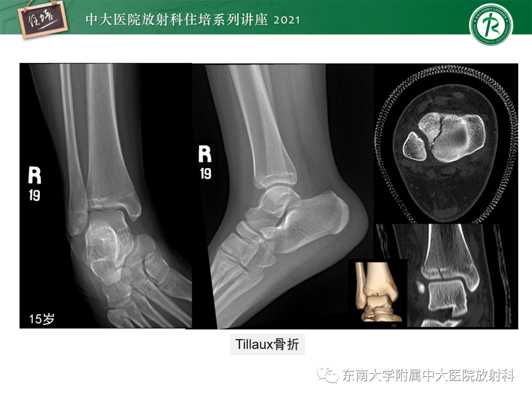 影像PPT - 【PPT】儿童骨关节损伤-67