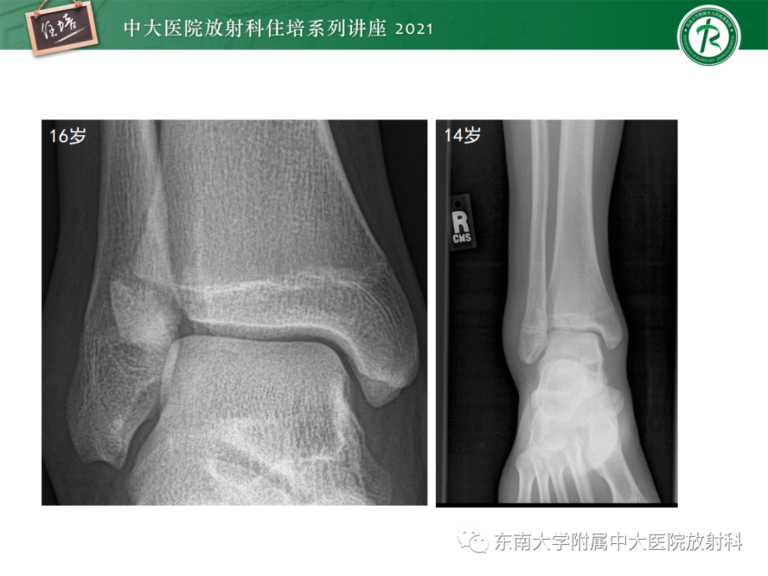 影像PPT - 【PPT】儿童骨关节损伤-68