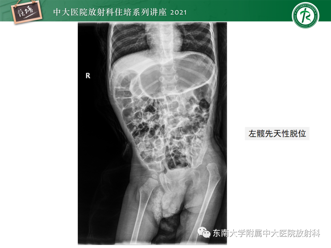 影像PPT - 【PPT】儿童骨关节损伤-71