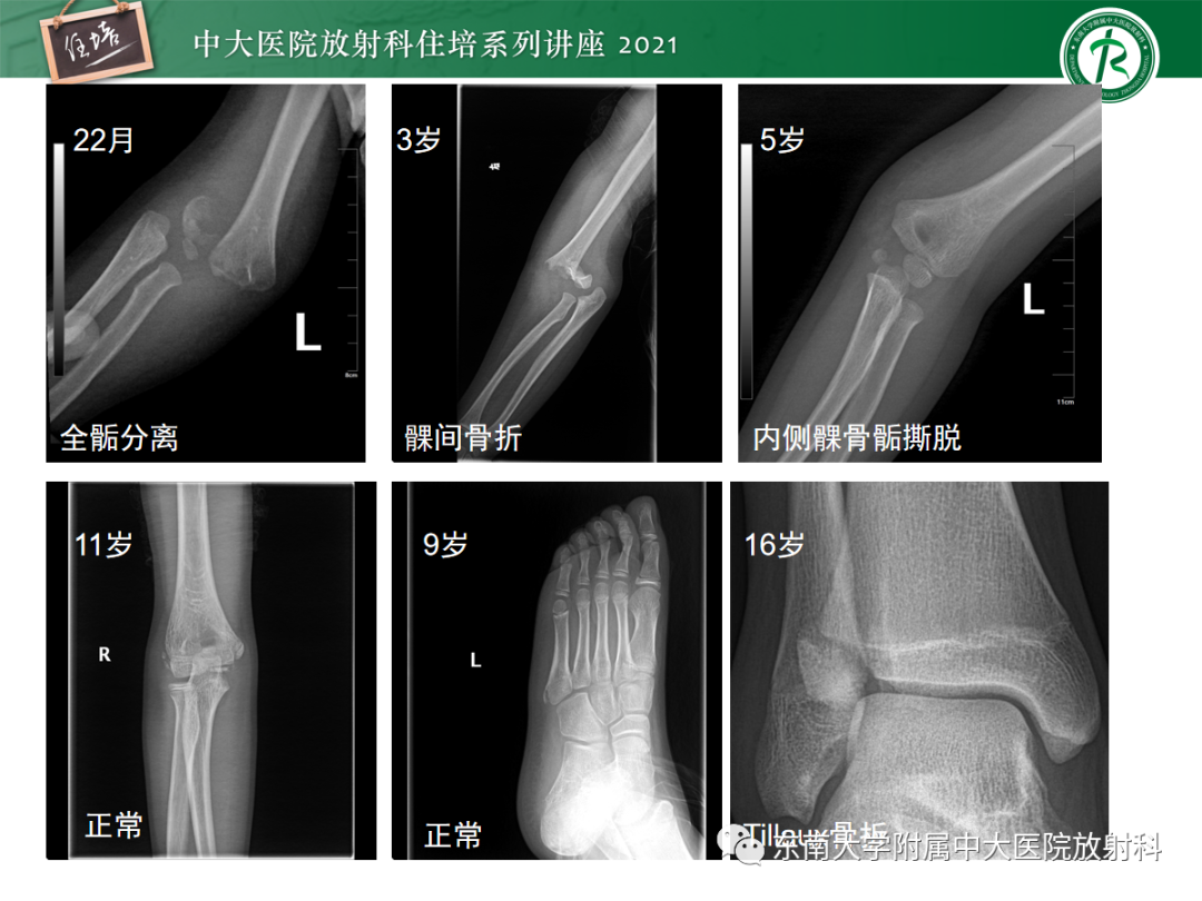 影像PPT - 【PPT】儿童骨关节损伤-72