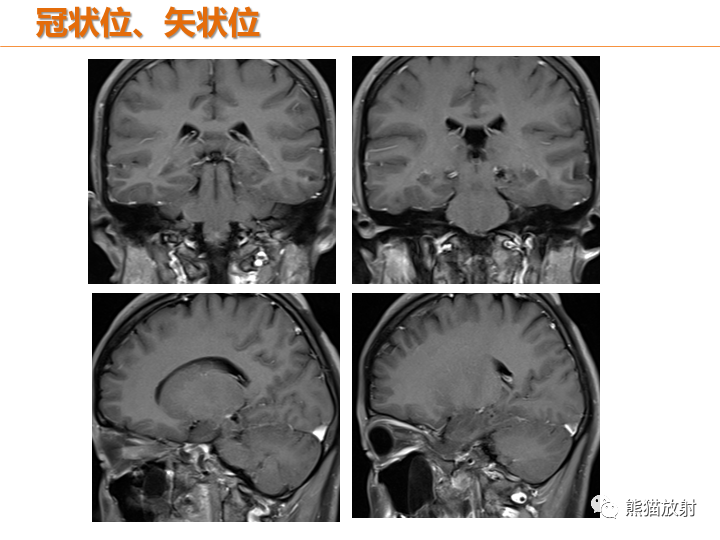 影像PPT - 【病例】弥漫型星形细胞瘤2例MR-6
