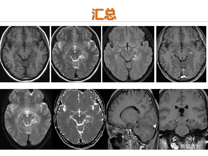 影像PPT - 【病例】弥漫型星形细胞瘤2例MR-7