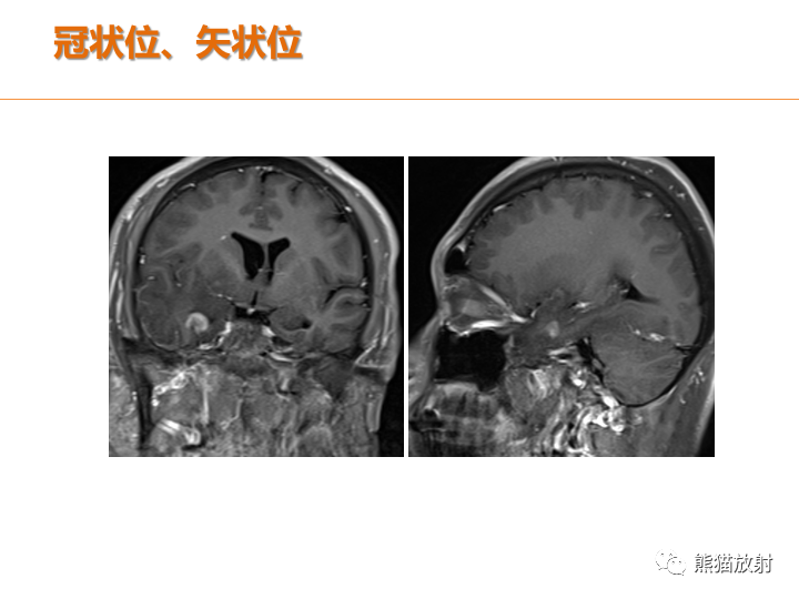 影像PPT - 【病例】弥漫型星形细胞瘤2例MR-13