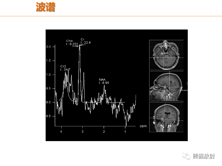 影像PPT - 【病例】弥漫型星形细胞瘤2例MR-14
