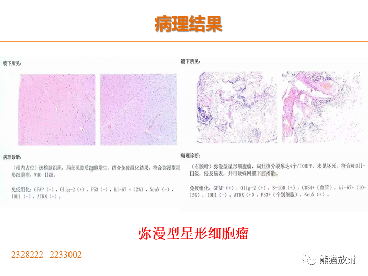 影像PPT - 【病例】弥漫型星形细胞瘤2例MR-17