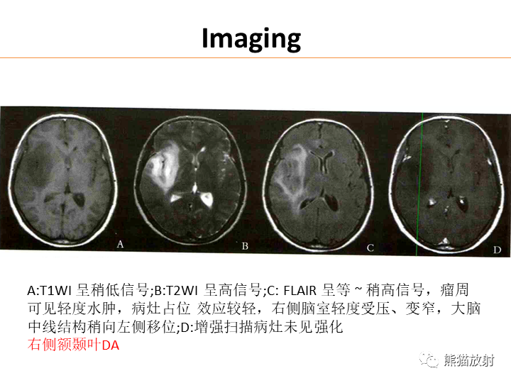 影像PPT - 【病例】弥漫型星形细胞瘤2例MR-27