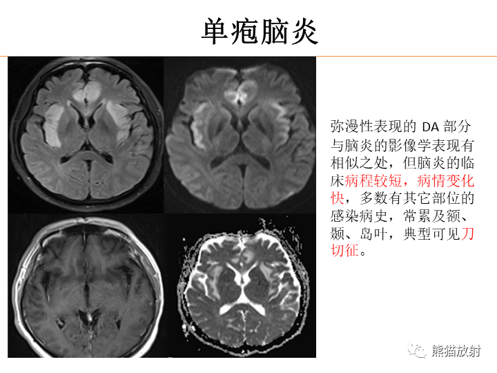 影像PPT - 【病例】弥漫型星形细胞瘤2例MR-31