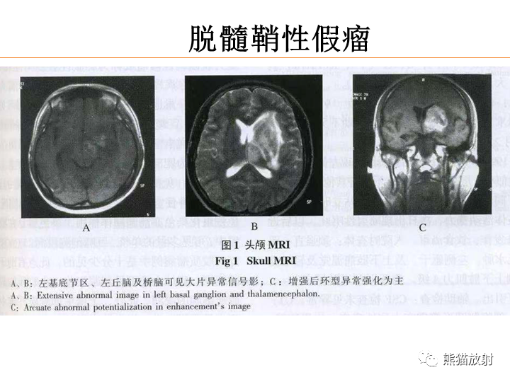 影像PPT - 【病例】弥漫型星形细胞瘤2例MR-34