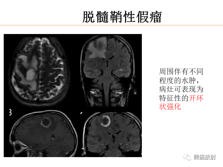 影像PPT - 【病例】弥漫型星形细胞瘤2例MR-33