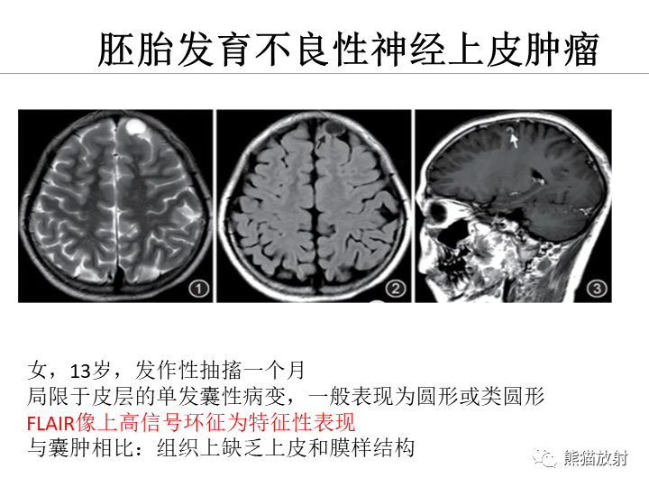 影像PPT - 【病例】弥漫型星形细胞瘤2例MR-37