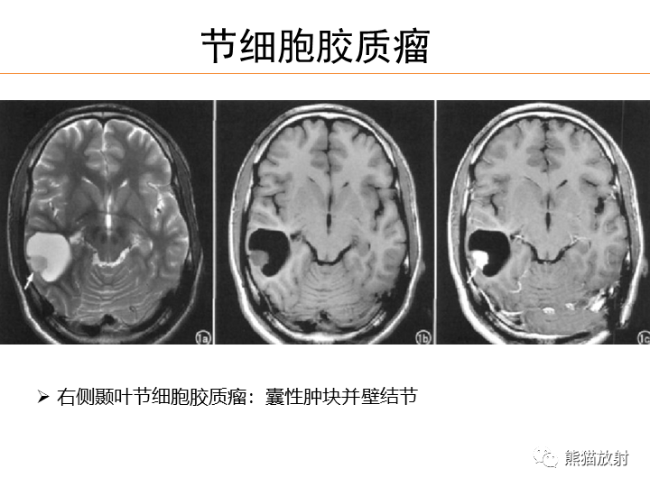 影像PPT - 【病例】弥漫型星形细胞瘤2例MR-39