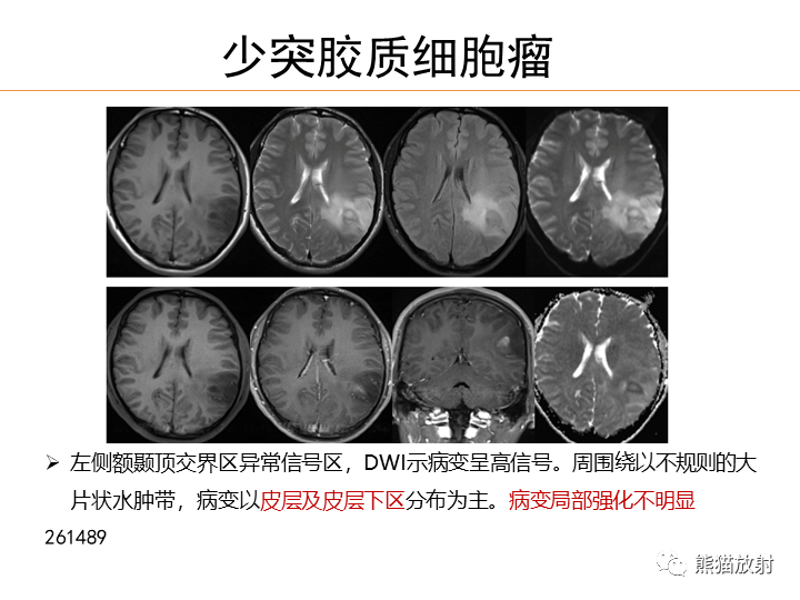 影像PPT - 【病例】弥漫型星形细胞瘤2例MR-41
