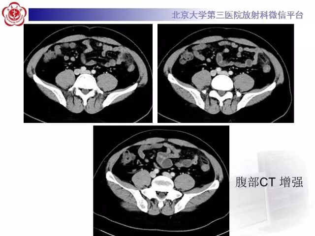 影像PPT - 【PPT】急性肠脂垂炎-3