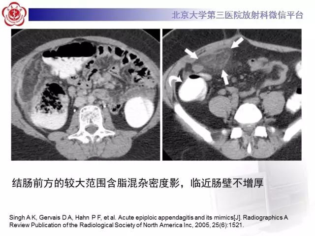 影像PPT - 【PPT】急性肠脂垂炎-18
