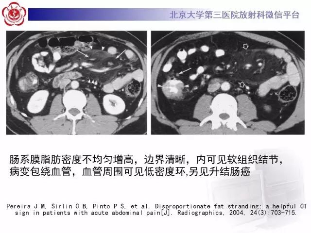 影像PPT - 【PPT】急性肠脂垂炎-20