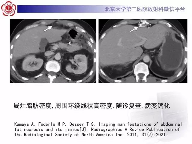 影像PPT - 【PPT】急性肠脂垂炎-22