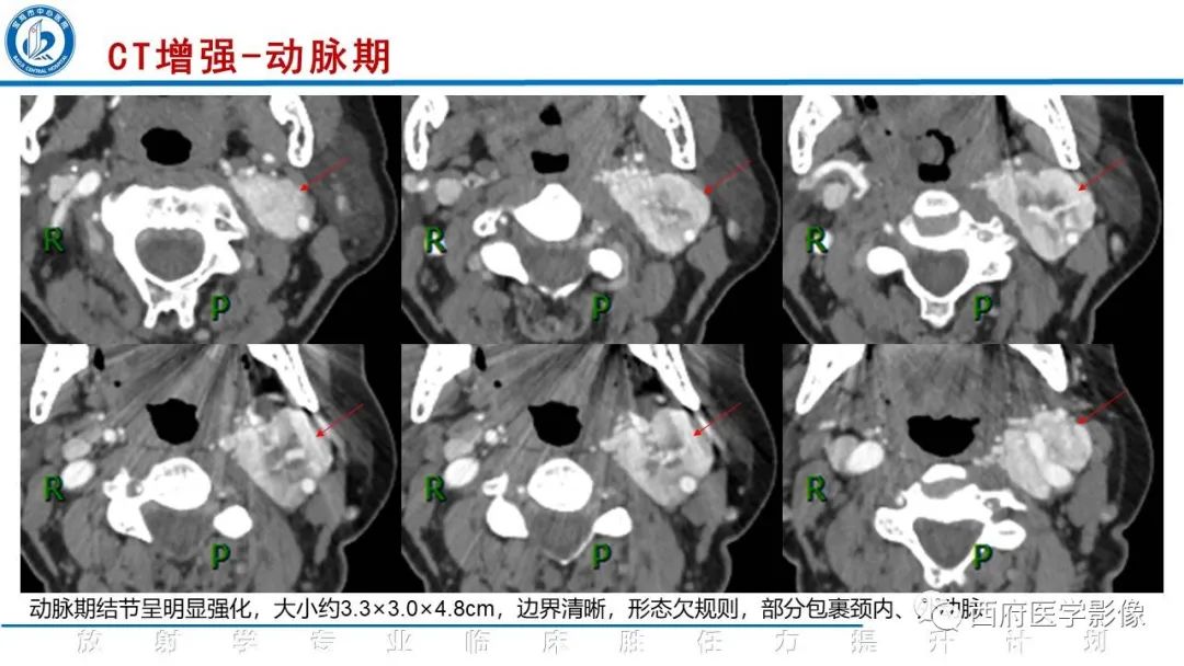 影像PPT - 【PPT】颈动脉体瘤的影像诊断-5