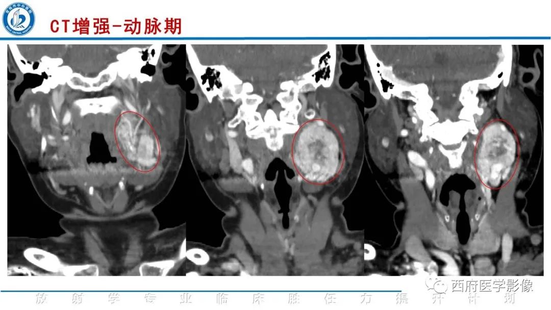 影像PPT - 【PPT】颈动脉体瘤的影像诊断-6