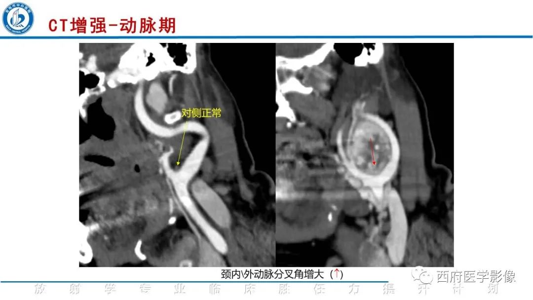 影像PPT - 【PPT】颈动脉体瘤的影像诊断-8