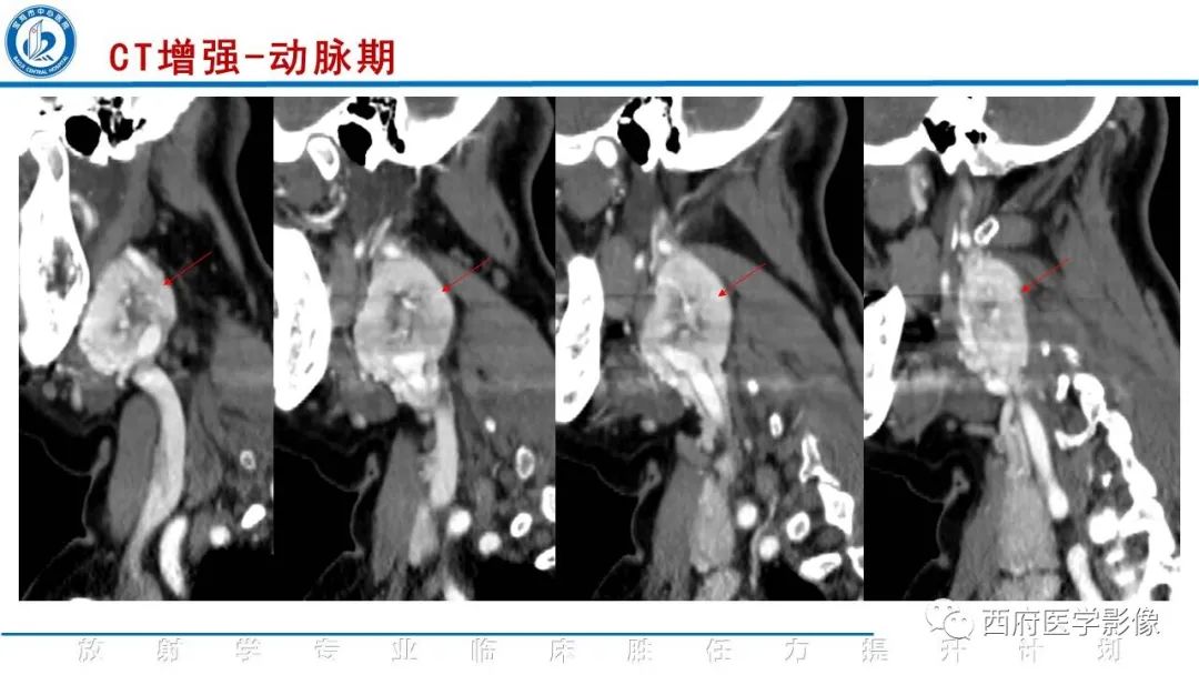 影像PPT - 【PPT】颈动脉体瘤的影像诊断-7