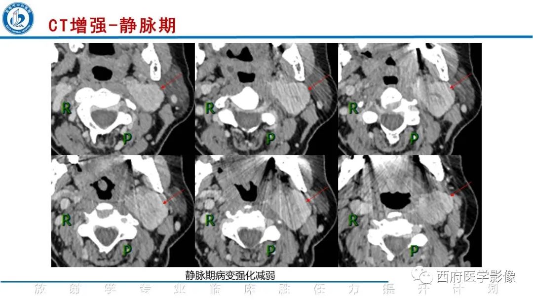 影像PPT - 【PPT】颈动脉体瘤的影像诊断-9