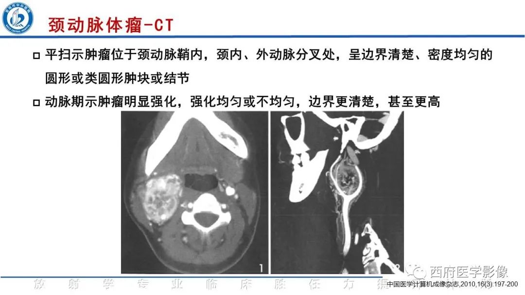 影像PPT - 【PPT】颈动脉体瘤的影像诊断-17