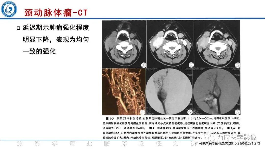 影像PPT - 【PPT】颈动脉体瘤的影像诊断-18