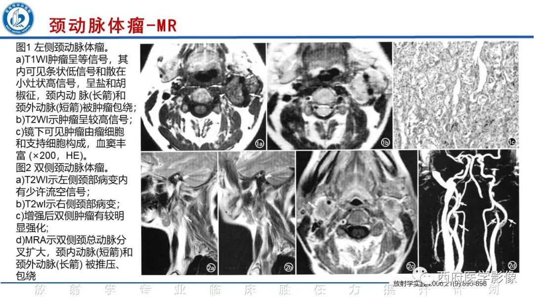 影像PPT - 【PPT】颈动脉体瘤的影像诊断-20