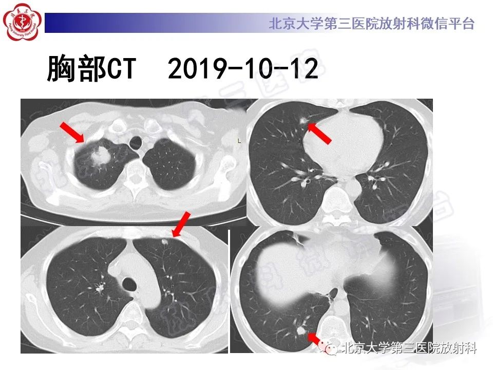 影像PPT - 【PPT】肺奴卡菌病-4