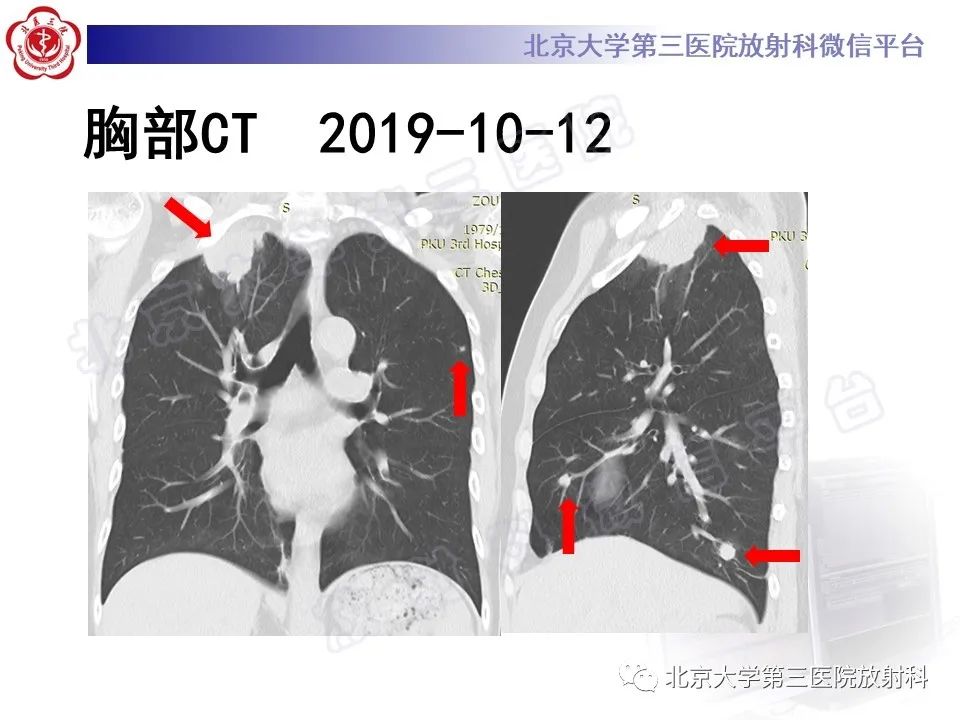 影像PPT - 【PPT】肺奴卡菌病-5