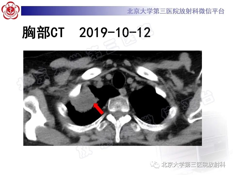 影像PPT - 【PPT】肺奴卡菌病-6
