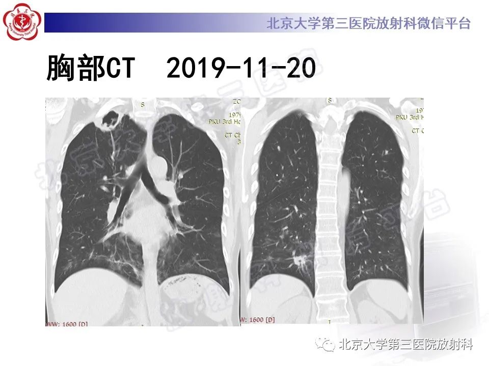 影像PPT - 【PPT】肺奴卡菌病-9