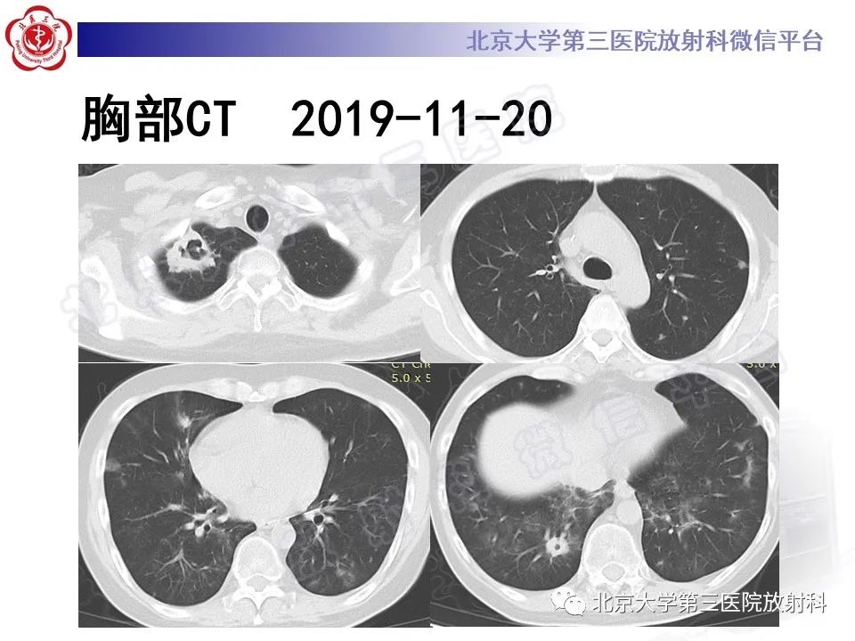 影像PPT - 【PPT】肺奴卡菌病-8