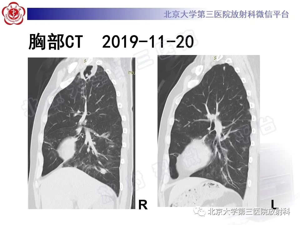 影像PPT - 【PPT】肺奴卡菌病-10